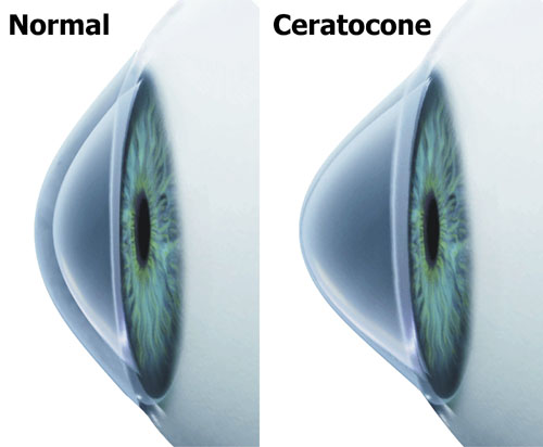 Ceratocone